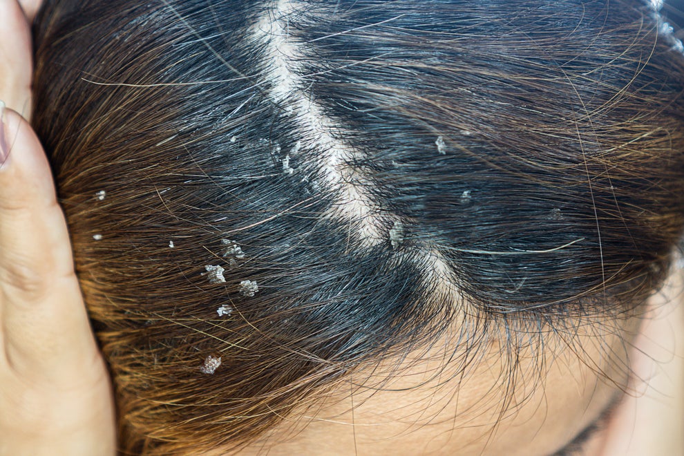 scalp buildup