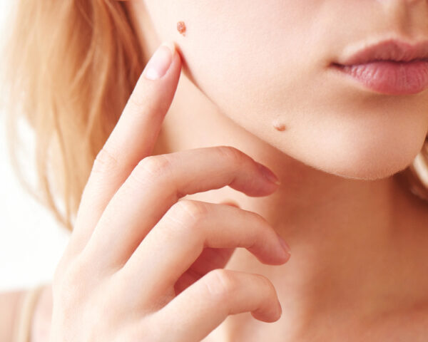 Unveiling Skin Tags: Your Secret Discomfort and Fast Removal Fixes!